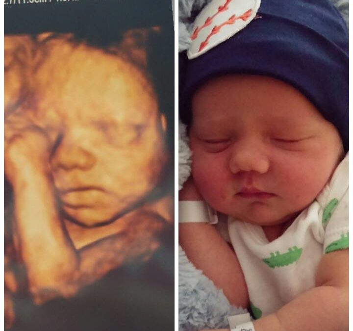 Before and After Ultrasound 2