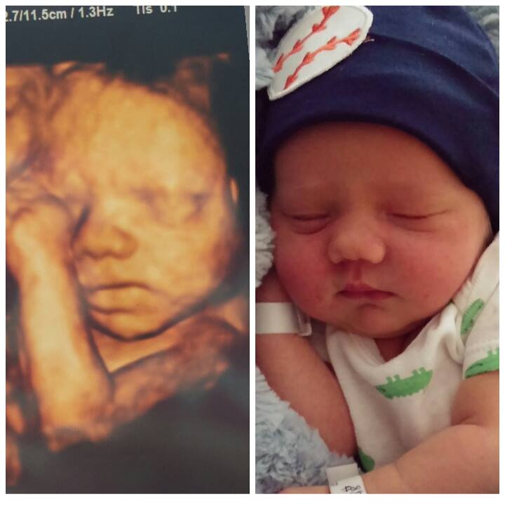 Before and After Ultrasound 2